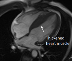 Thickened heart muscle