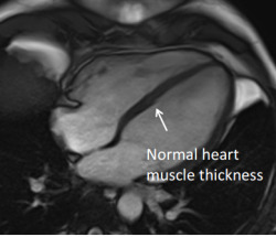 Normal heart muscle thickness